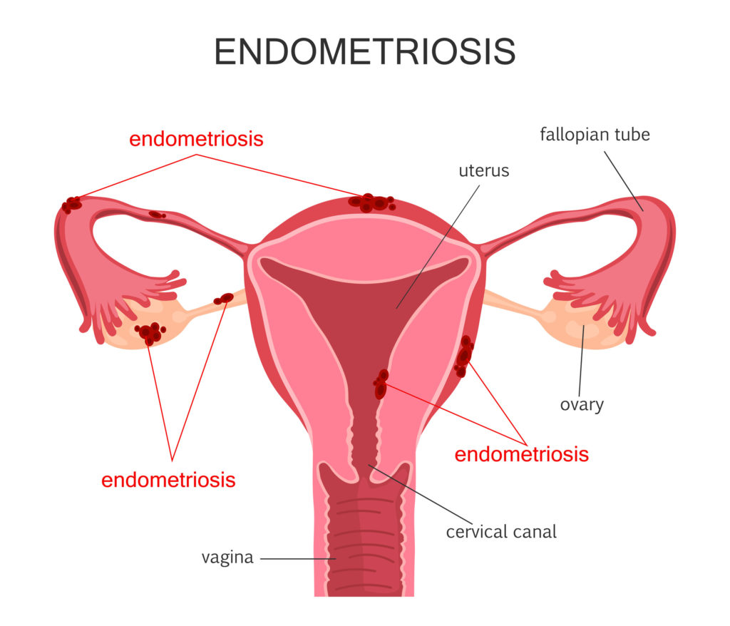 ¿Marihuana medicinal para la endometriosis? - WeedSeedShop