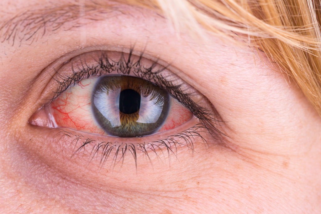 Pourquoi la weed rend-elle les yeux rouges ? - WeedSeedShop Blog 